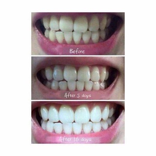 Bột trắng răng baking soda