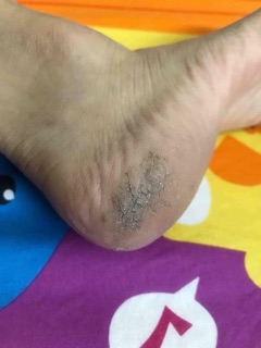 [HCM] Kem trị nứt gót chân thái