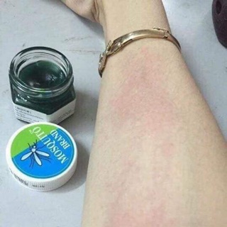 Kem bôi muỗi đốt