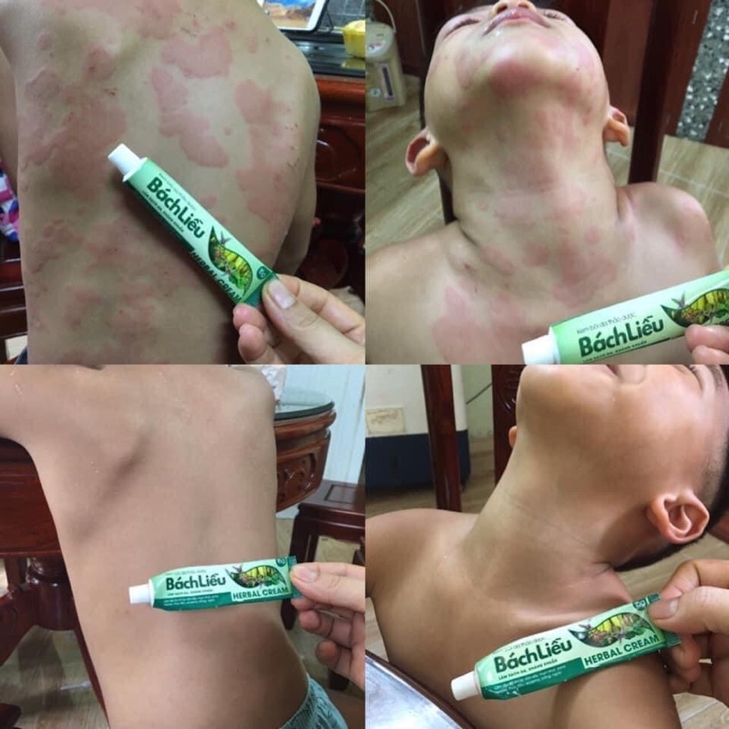 Kem Bôi Da Thảo Dược Bách Liễu 15g