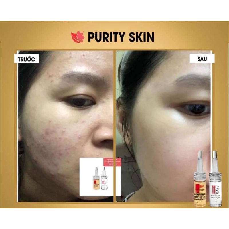 [CHÍNH HÃNG] BỘ GIẢM MỤN, NGỪA MỤN PURITY SKIN mua kèm Nước Tẩy Trang | BigBuy360 - bigbuy360.vn