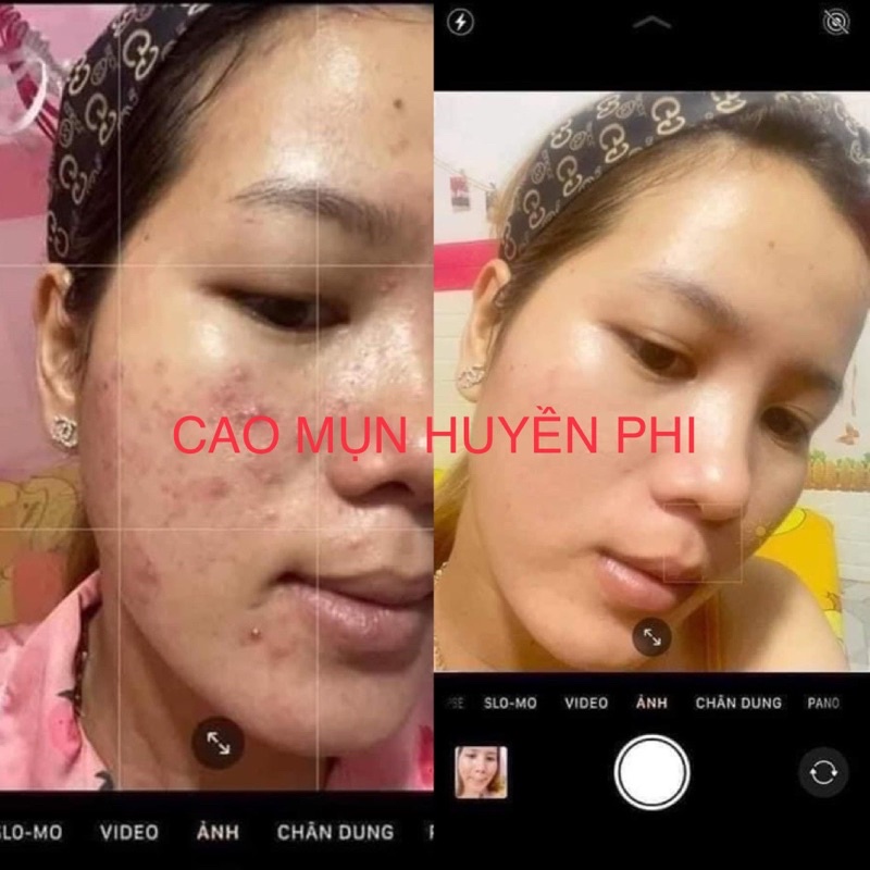 [SP CHÍNH HÃNG] Cao Mụn Tảo Nâu Huyền Phi - Loại Bỏ Mụn Hoàn Toàn, Tái Tạo Da Mịn Màng Căng Bóng | BigBuy360 - bigbuy360.vn