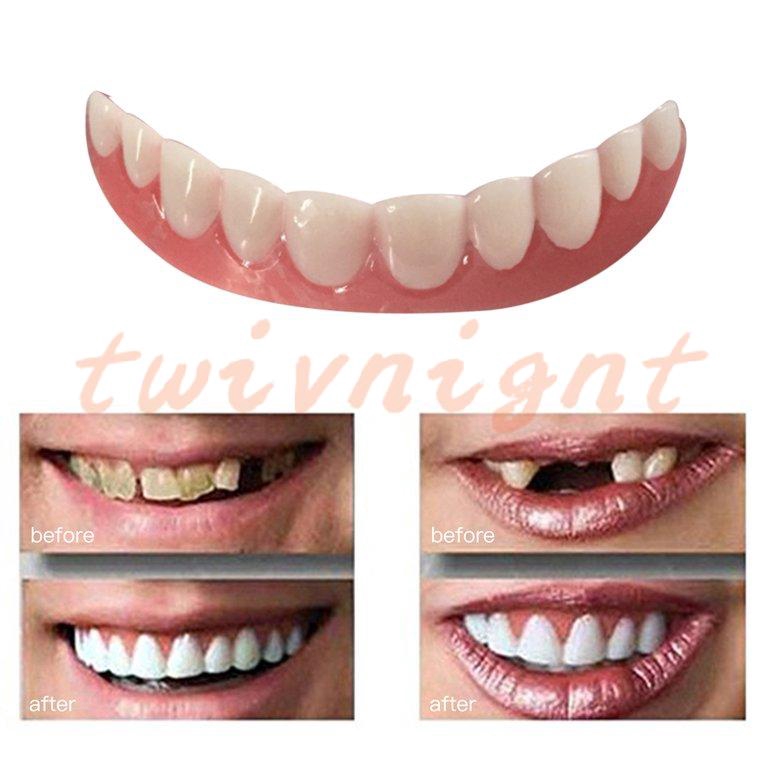 Răng giả dán hàm trên làm trắng vừa vặn thoải mái tạo nụ cười hoàn hảo nhanh chóng