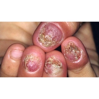 Dung Dịch Nấm Móng ,Phục Hồi Móng Hư Tổn (1 chai)