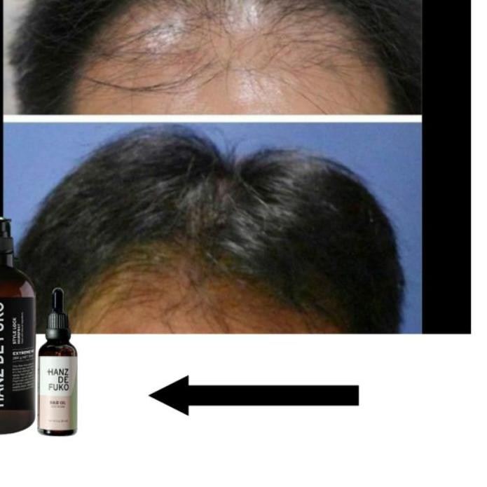 (Hàng Mới Về) Serum Kích Thích Mọc Tóc Hanz De Fuko Baldness