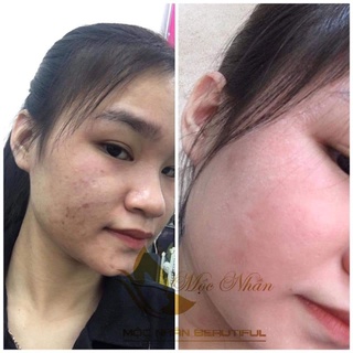 Cốt Nhân Sâm Tái Tạo Da Mộc Nhân