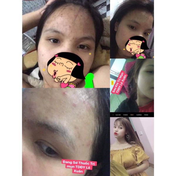 Ngừa mụn Lê Xuân🍀thảo dược đông y lê xuân🍀loại bỏ mụn trứng cá, mụn ẩn, mụn viêm,… | BigBuy360 - bigbuy360.vn