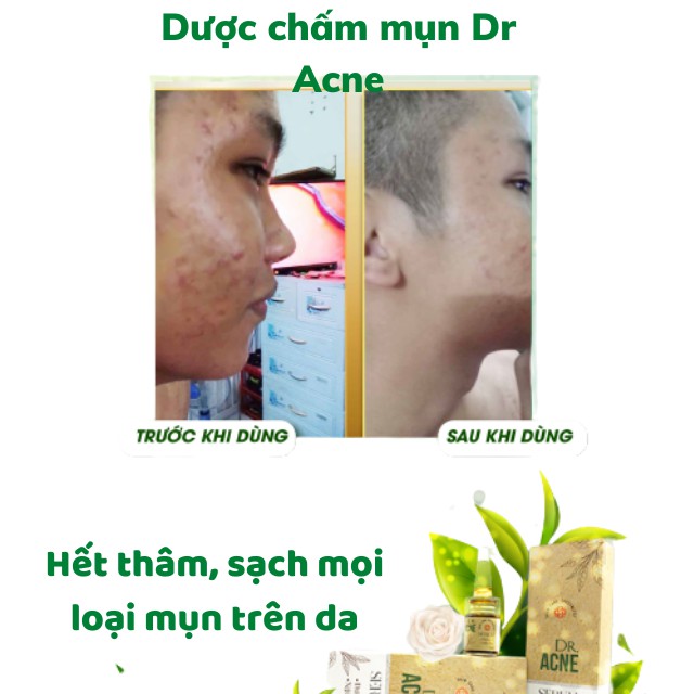 Serum Dưỡng Da Dr Acne Sạch Mụn, Mờ Thâm, Liền Sẹo- Hà Mi mart | BigBuy360 - bigbuy360.vn
