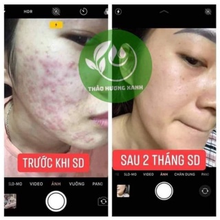 THẢO HƯƠNG XANH  SẠCH MỤN,HẾT THÂM