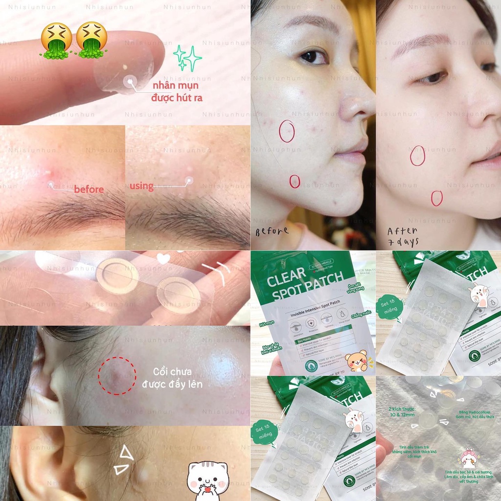 Miếng dán Some by mi Clear Spot patch