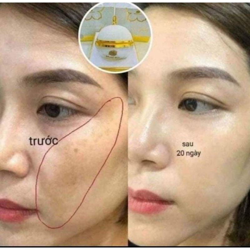 Cao ngừa nám CAO NÁM MAGIC SKIN | BigBuy360 - bigbuy360.vn