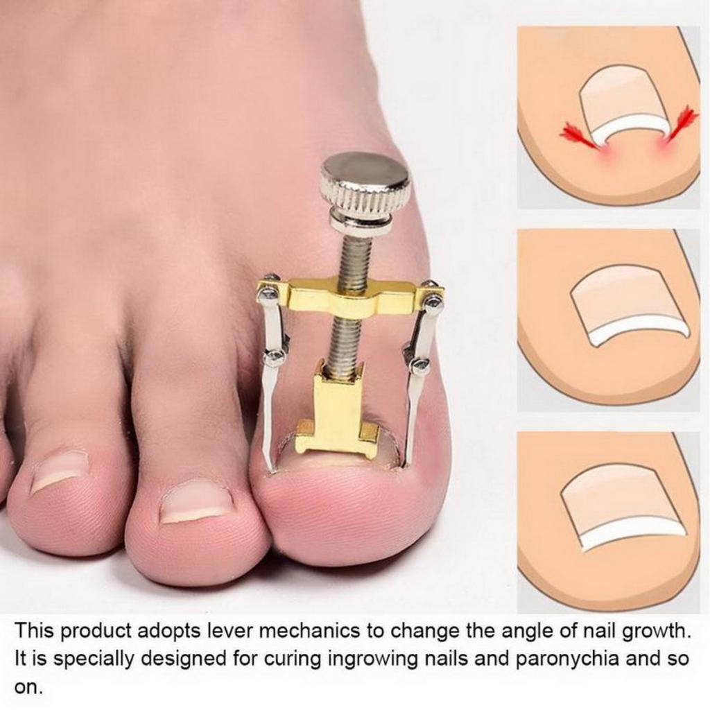 Ingrown Toenail Corrector Pedicure Tool Foot Nail Orthotic Correction Golden