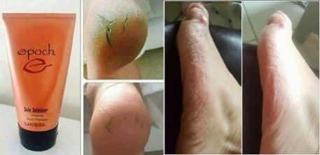 KEM TRỊ NỨT GÓT CHÂN SOLE SOLUTION FOOT TREATMENT