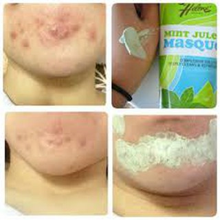 Mặt nạ Queen Helene Mint Julep Masque!!