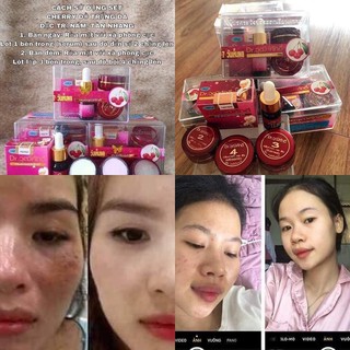Bộ Nám và Sạm Da yanhee (mẫu mới tuýp nám)