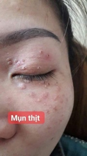 Chấm tàn nhang 7 ngày bong