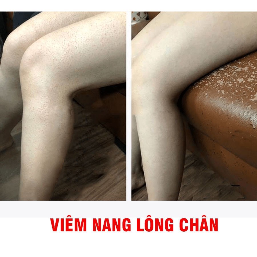 Muối Tắm Tinh Chất Sữa Non Lasenta Hết Mụn Lưng, Viêm Nang Lông