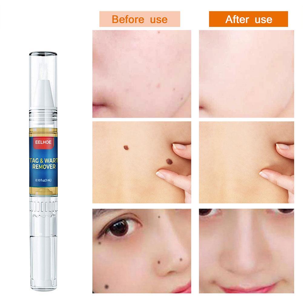 Bút Tẩy Nốt Ruồi Và Mụn Đầu Đen Làm Mịn Da P6I5