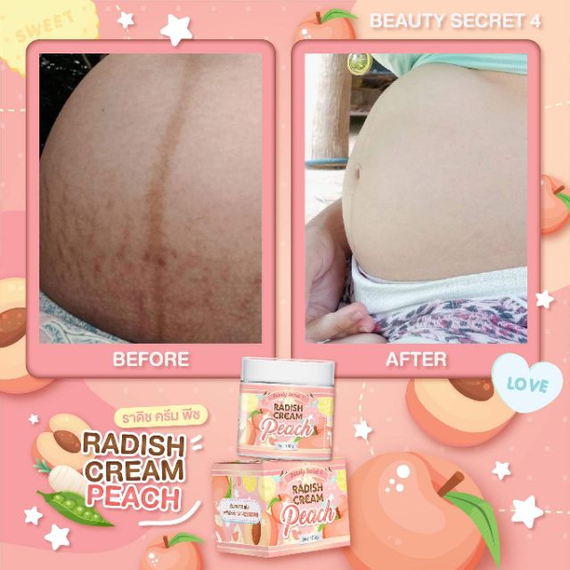 Kem Ngăn Ngừa Thâm, Rạn Da, Mờ Sẹo, Dưỡng Trắng Toàn Thân RADISH CREAM PEACH Beauty Secret 4 100g - Thái Lan | BigBuy360 - bigbuy360.vn