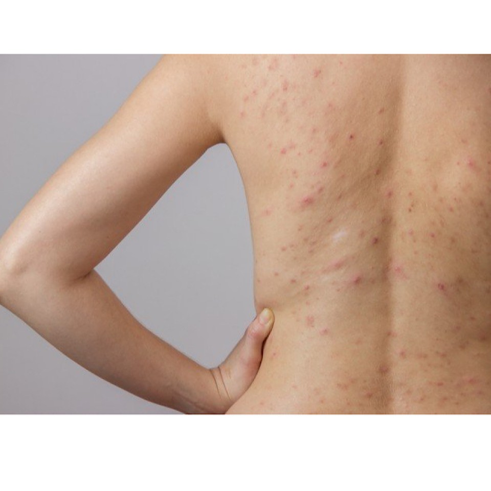 Xà phòng Amore giảm mụn lưng, mụn mông, nang lông 70g - AB Authentic | BigBuy360 - bigbuy360.vn