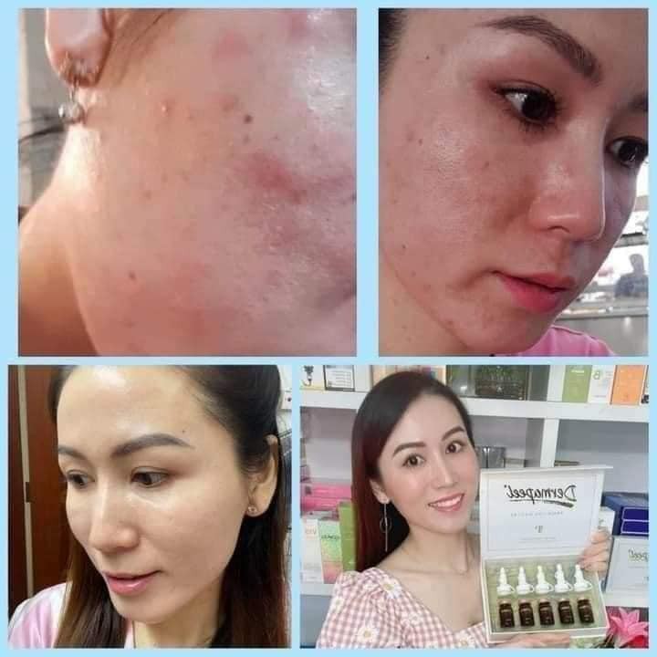 Tảo trứng cá tuyết Dermapeel+ KHÔNG BONG DA - Vì Làn Da Hoàn Hảo - SẠCH MỤN - MỜ THÂM NÁM - TÁI TẠO MÔ DA HQ