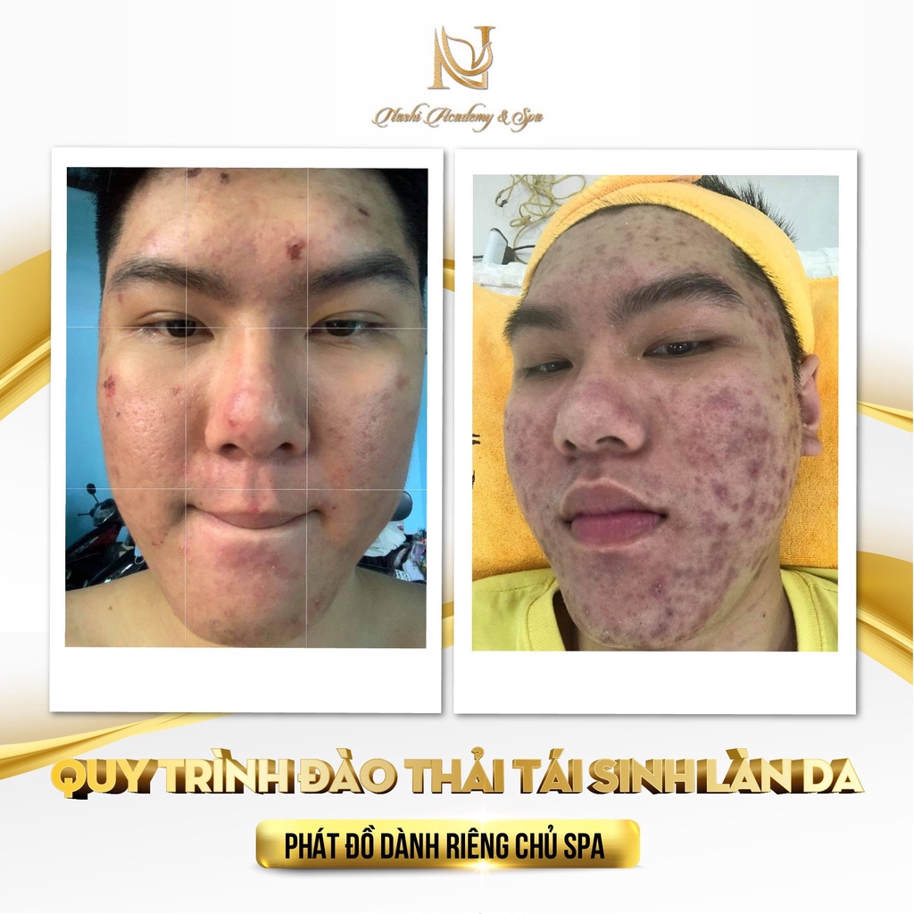 Combo Hỗ Trợ Làm Giảm Mụn Sưng Mụn Kích Ứng
