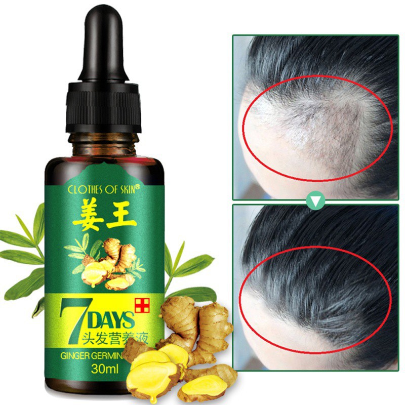 Tinh Chất Gừng Kích Thích Mọc Tóc Cho Nam Và Nữ