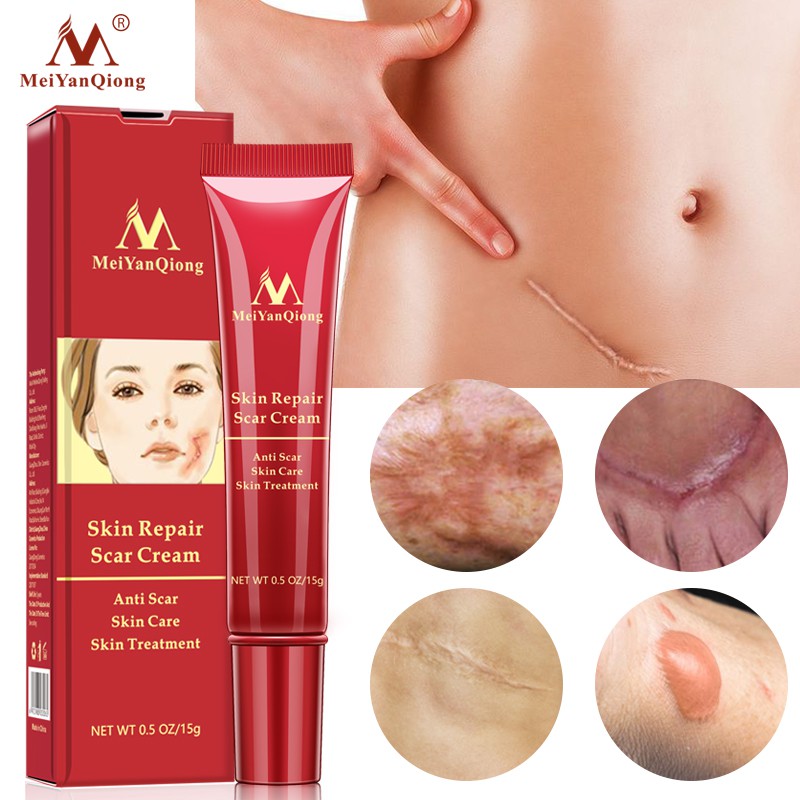 MeiYanQiong Acne Scar Removal Cream Skin Repair Stretch Marks giảm sẹo lồi, lõm, sẹo thâm, do mụn giúp phục hồi các tổn thương trên da thúc đẩy tái tạo da 15ml