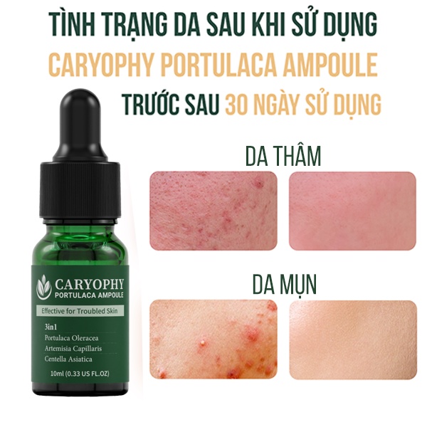 Serum rau má giảm mụn mờ thâm Caryophy Portulaca Ampoule (10ml 30ml)