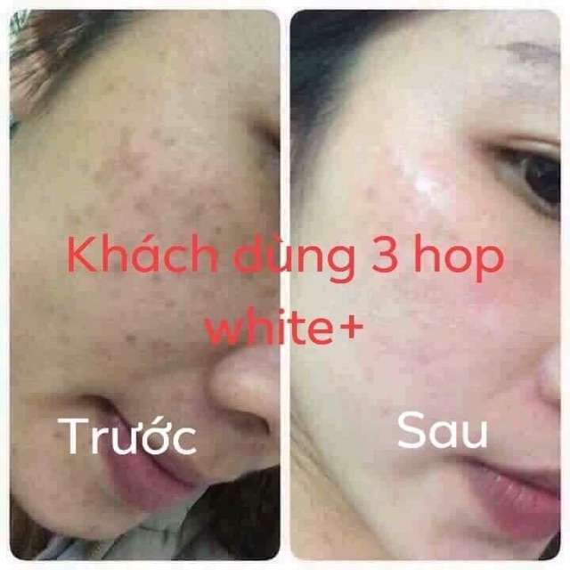 Viên uống trắng da, mờ nám, trị mụn white+++ | BigBuy360 - bigbuy360.vn