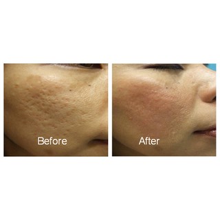 ✅ Kim lăn chuẩn y tế DermaRollerVN