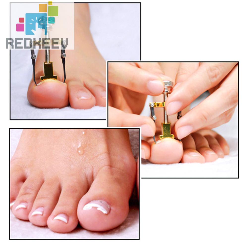 Dụng Cụ Chỉnh Sửa Móng Chân Mọc Ngược