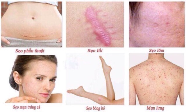 Kem sẹo Gentacin Nhật Bản 10gr