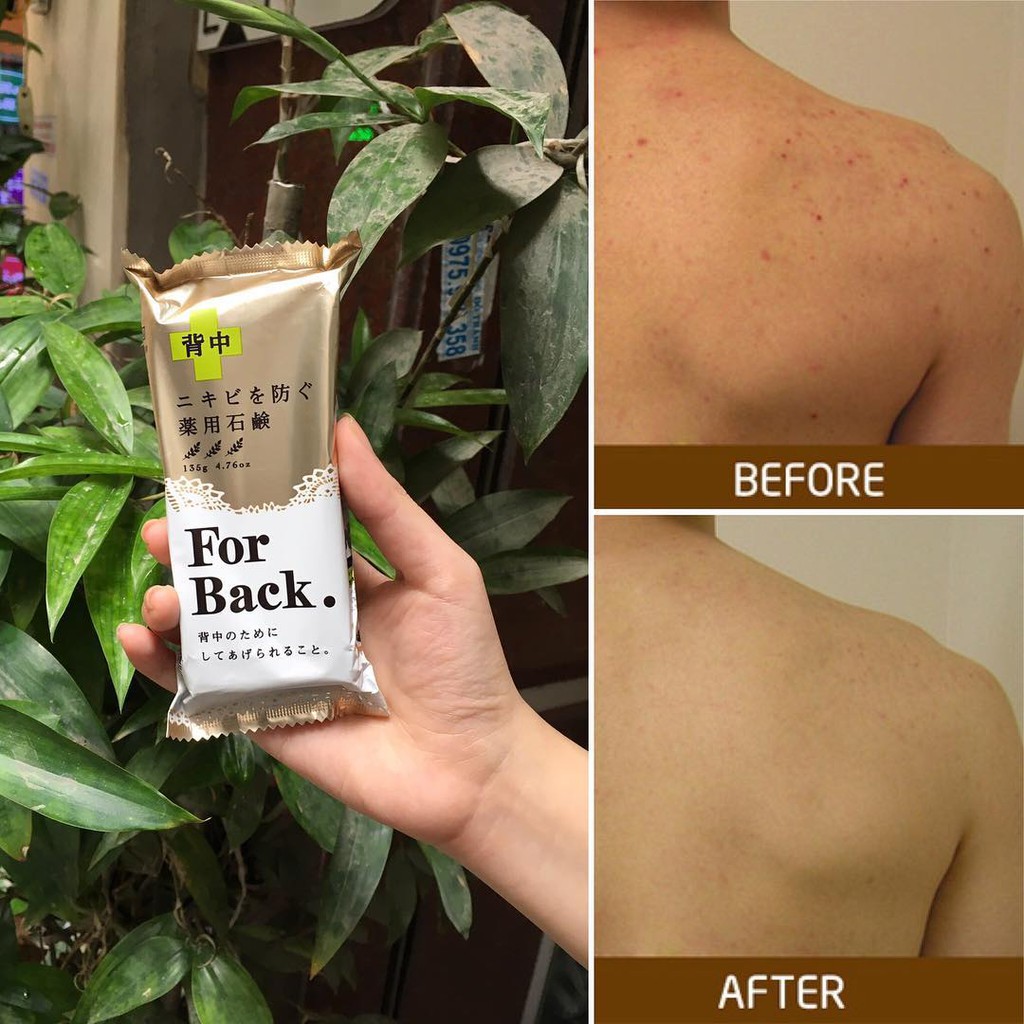 Xà Phòng Mụn Lưng For Back Medicated Soap