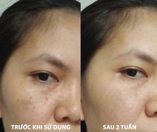 Bút chấm nám eucerin