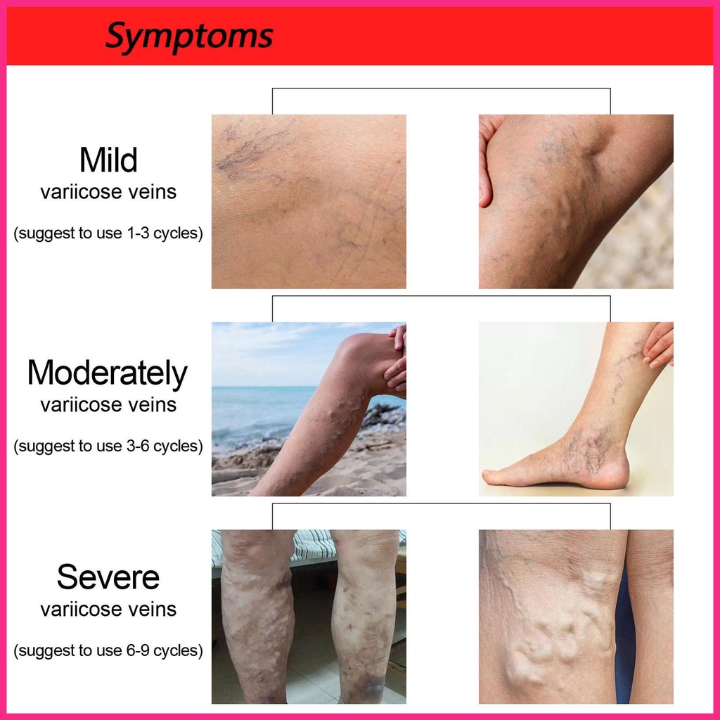 Bộ 12 Miếng Dán Trị Giãn Tĩnh Mạch Cao Cấp Chuyên Dụng