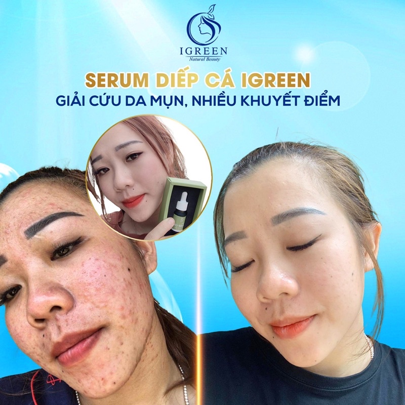 Serum IGREEN Diếp cá Sạch mụn, mờ thâm, thu nhỏ lỗ chân lông 10ml | BigBuy360 - bigbuy360.vn