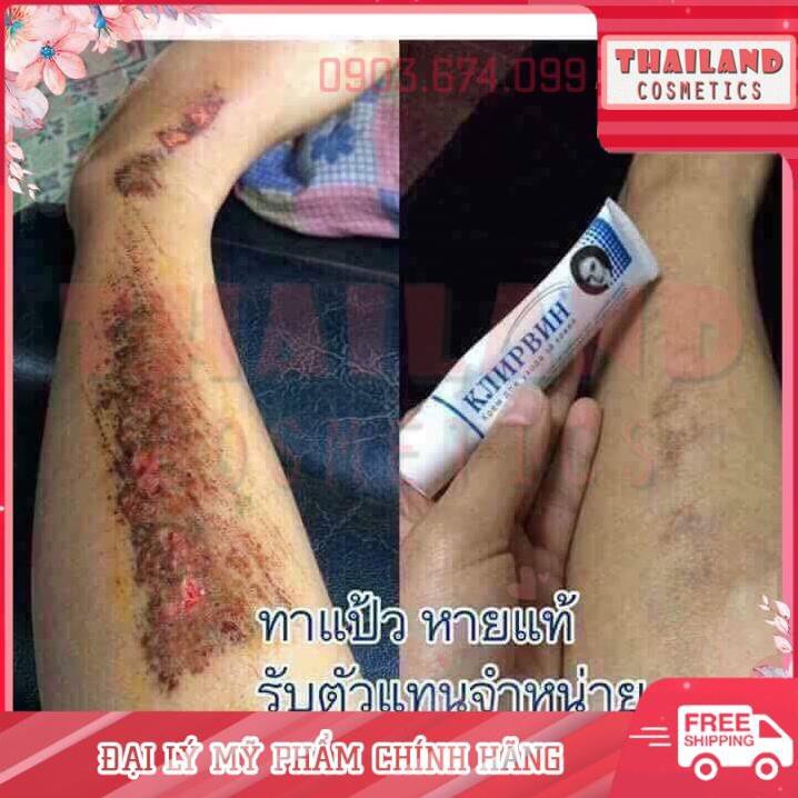 Kem hỗ trợ mờ sẹo mờ thâm, rạn da Klirvin Nga 25G