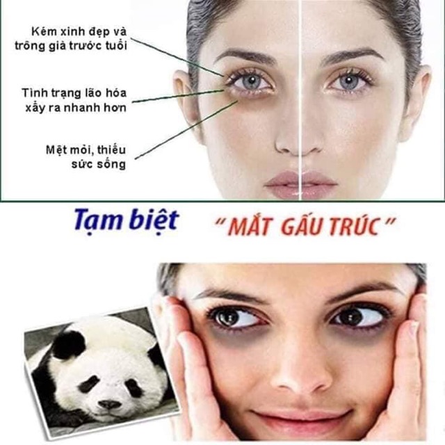 Kem làm tan thâm quầng thâm và tan bọng mắt Nga