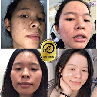 Combo Hoàng Thiên Sâm - Tái Tạo Da