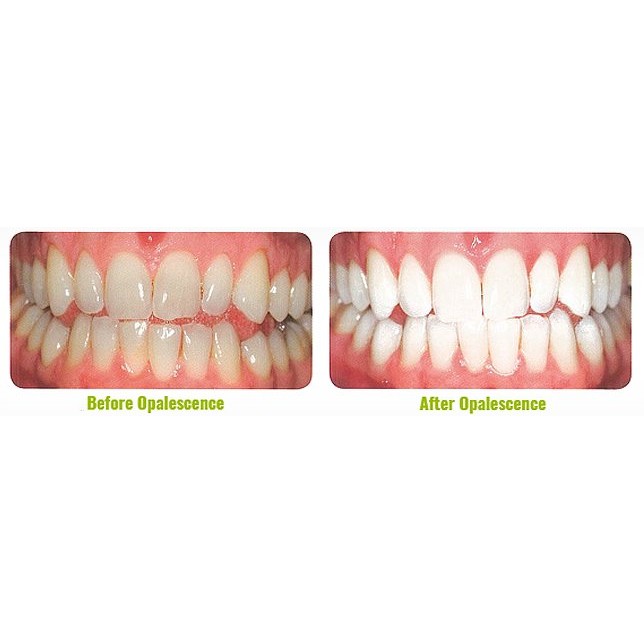 Tẩy trắng răng tại nhà Opalescence 10% 15% 20% 35% ( 01 ỐNG)