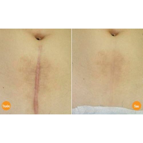 Kem Xóa Sẹo Thâm / Rỗ / Lồi / Lõm Strataderm 10g - Gel Hỗ Trợ Giảm Sẹo Ngăn Ngừa Sẹo Xấu