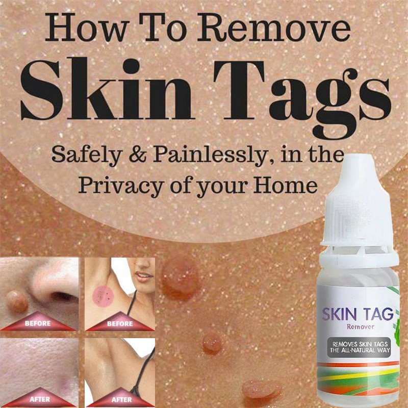 Skin Tag Remover 12 Hours Tu Kill Tu Kill Remover Skin Tag Mole & Genital Wart Remover Foot Corn Removal 10Ml