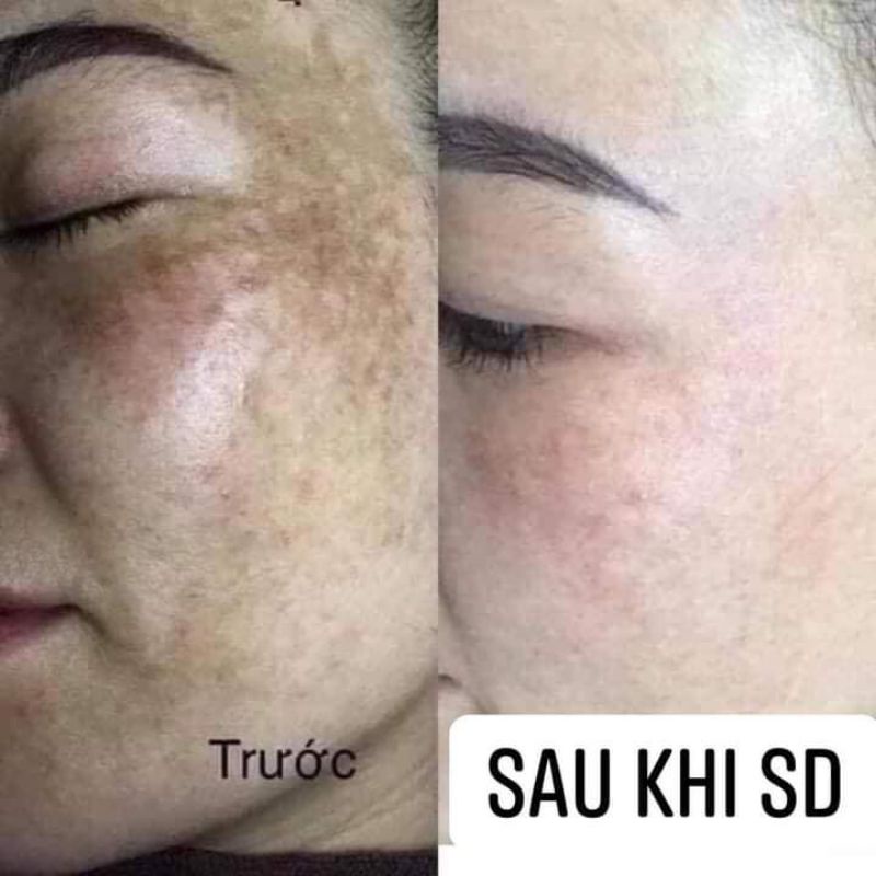 Kem nám YOSKI, mờ nám,tàn nhang,thâm sạm, tái tạo da, giúp da trắng sáng mịn màng 20gram