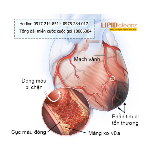 Lipid Cleanz - Giảm cholesterol trong máu, điều hòa mỡ máu, giảm sơ vữa động mạch (Hộp 30 viên)