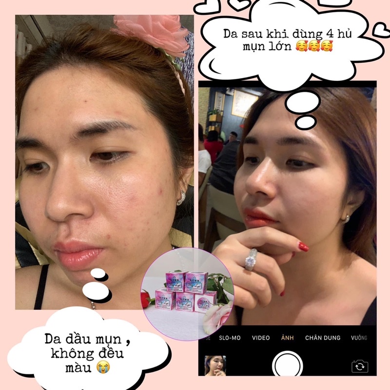 KEM ACNE MỸ LYN KÈM GIẤY HDSD + TÚI ĐỰNG