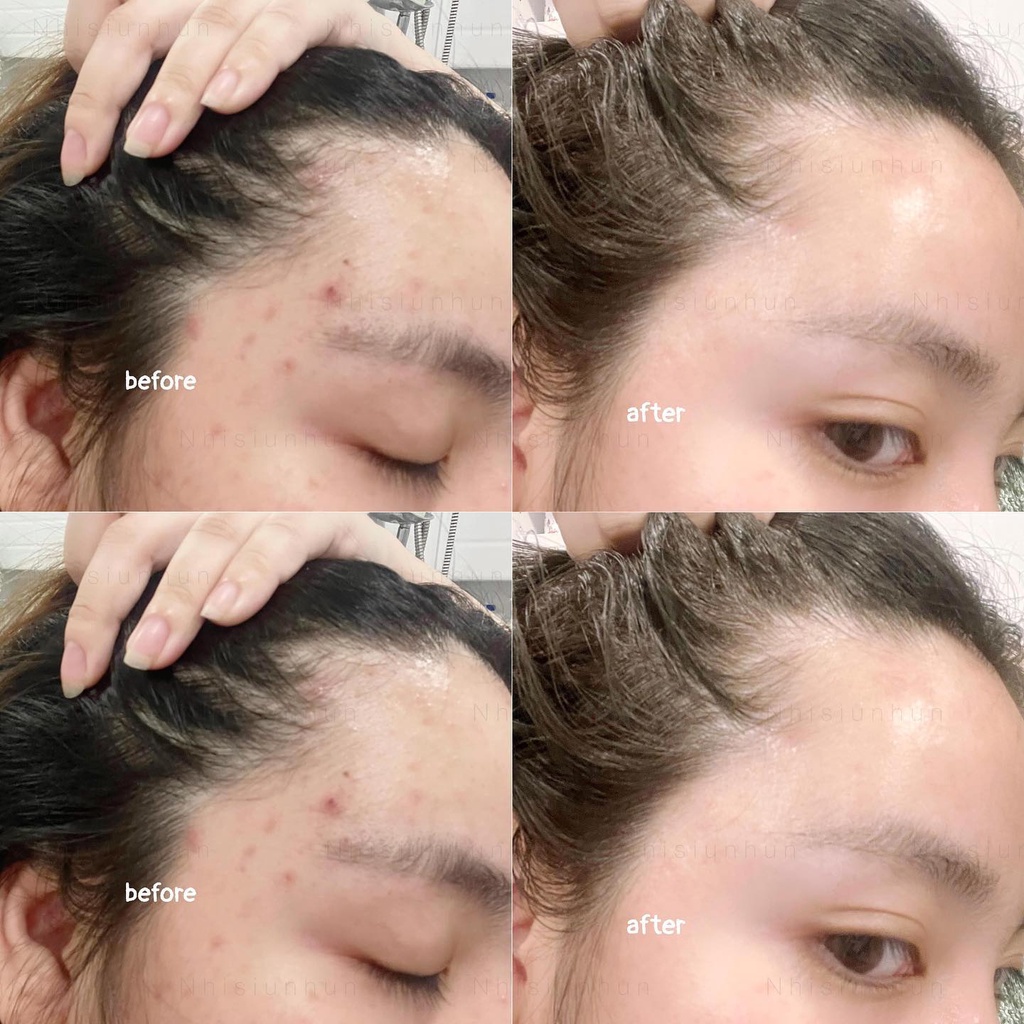 Serum rau má Skin1004 Madagascar Centella Asiatica 100 Ampoule