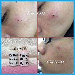 Tẩy Mụn Cóc Nốt Ruồi Tàn Nhang Mắc Cá ,Mụn Thịt