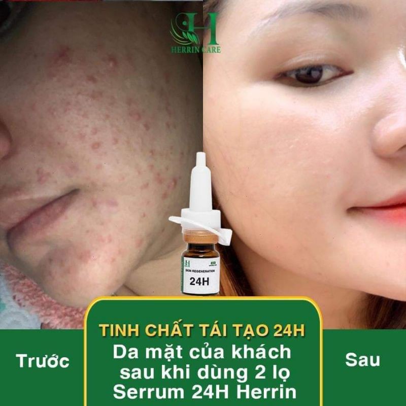 SERUM MỤN 24H HERRIN CARE ĐÁNH BAY TẤT CẢ CÁC LOẠI MỤN-KHÔNG SƯNG-KHÔNG BONG-KHÔNG ĐỎ-8ML | BigBuy360 - bigbuy360.vn