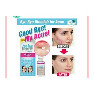 Kem Chấm Mụn Bye Bye Blemish Drying Lotion